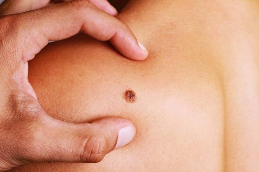 Cancer De Piel El Tratamiento Que Permite Que El 52 De Pacientes Con Melanoma Avanzado Sobreviva Al Menos 5 Anos