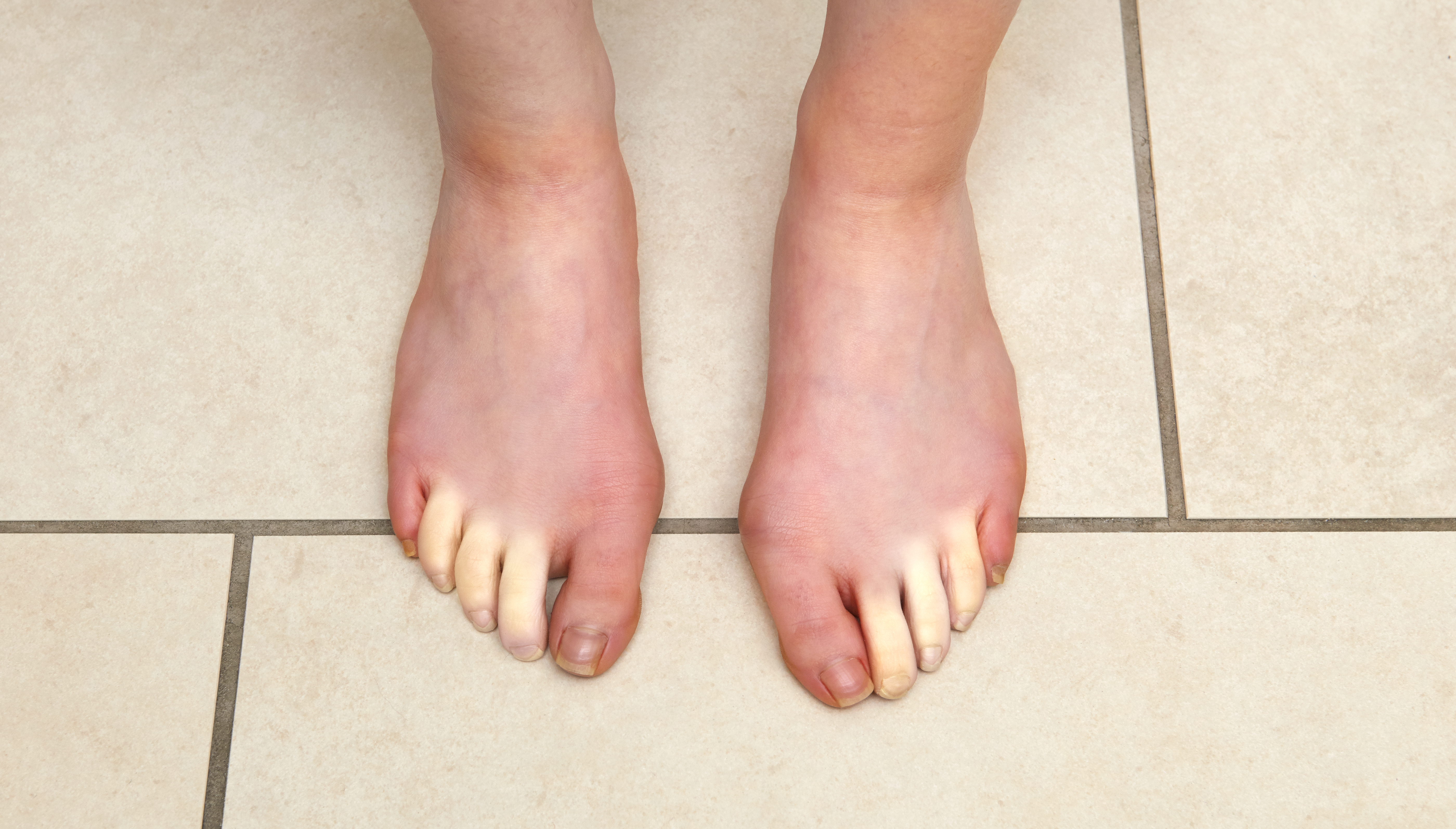 Señales y síntomas que pueden indicar mala circulación sanguínea en piernas  y pies