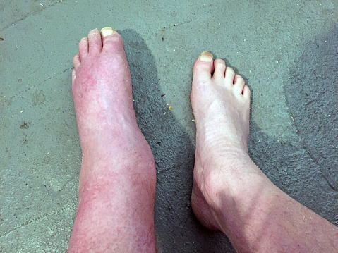 Remedios caseros para los pies inlfamados.