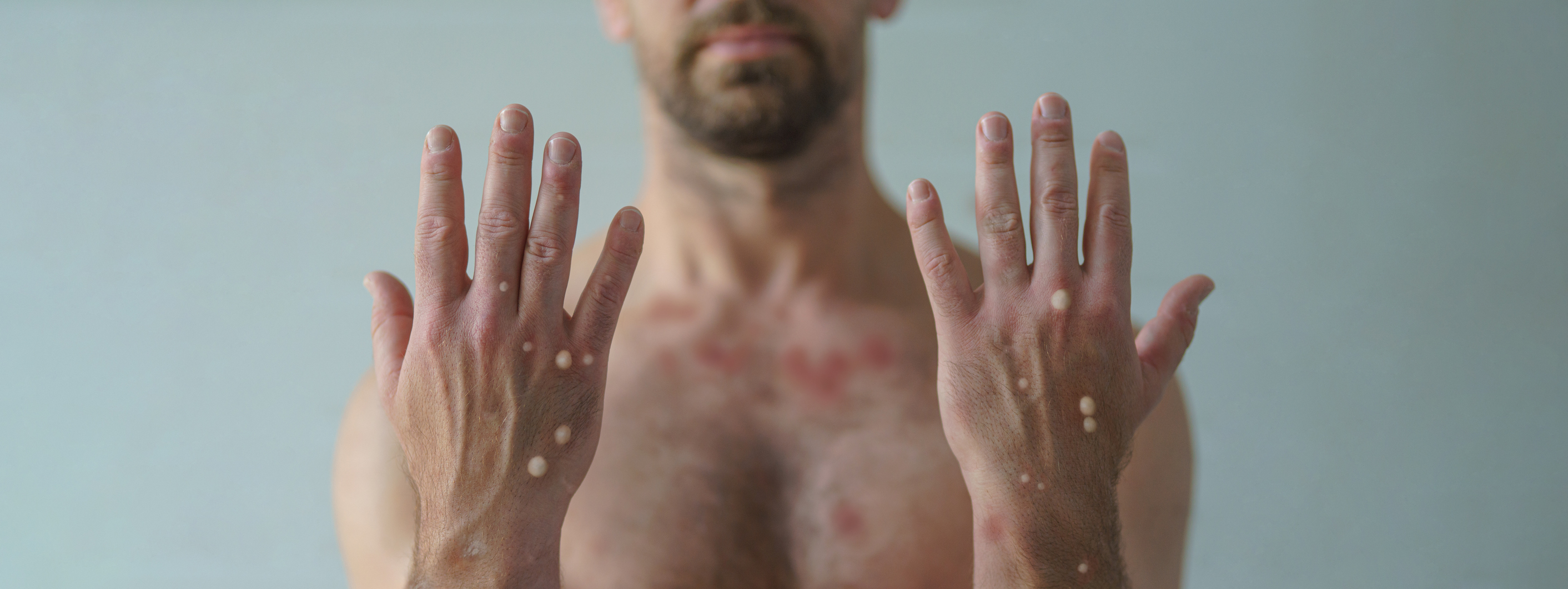 Manos masculinas afectadas por una erupción con ampollas debido a la viruela del mono