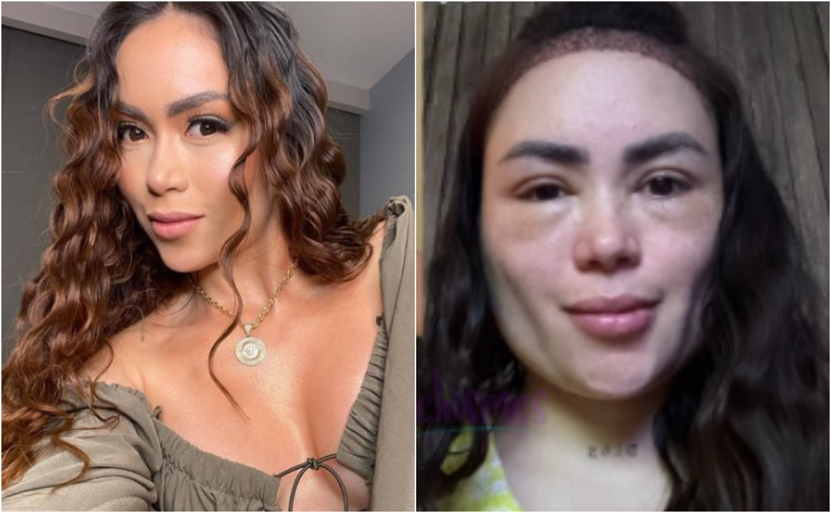 Epa Colombia se realizó un nuevo tratamiento estético, pero tuvo una reacción en el rostro que llamó la atención.