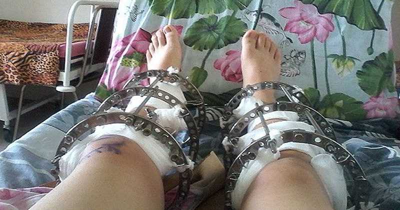 El proceso de recuperaci&oacute;n es largo y dura varios meses.