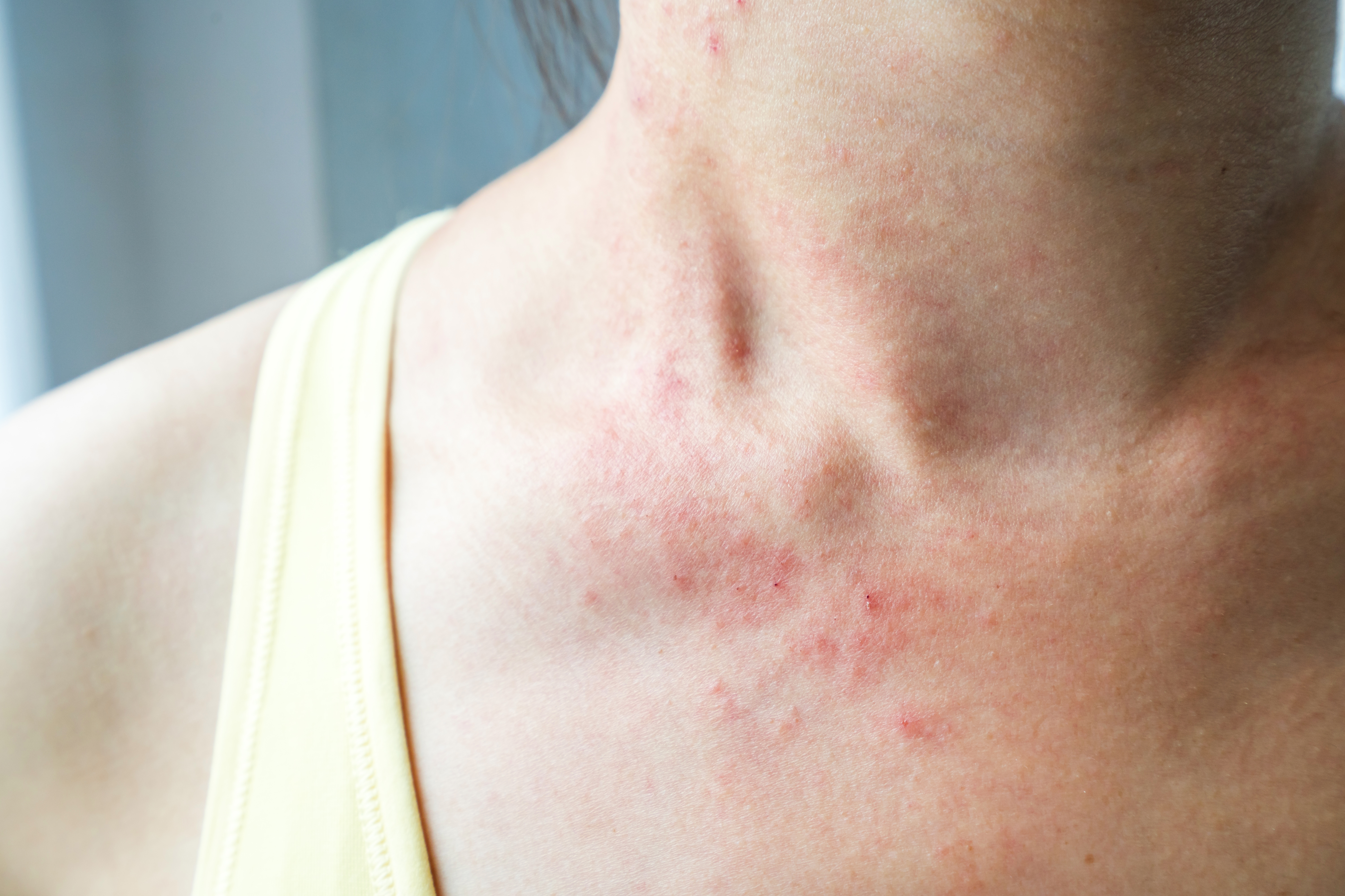 Conciencia Sofocar bandeja Manchas rojas en el cuello: ¿cuáles son sus causas?