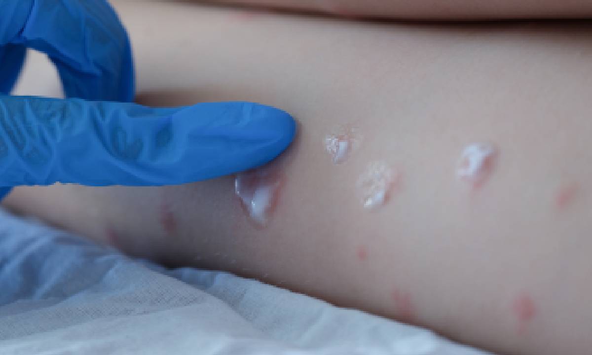 Massachusetts, confirma primer caso de viruela del mono en Estados Unidos