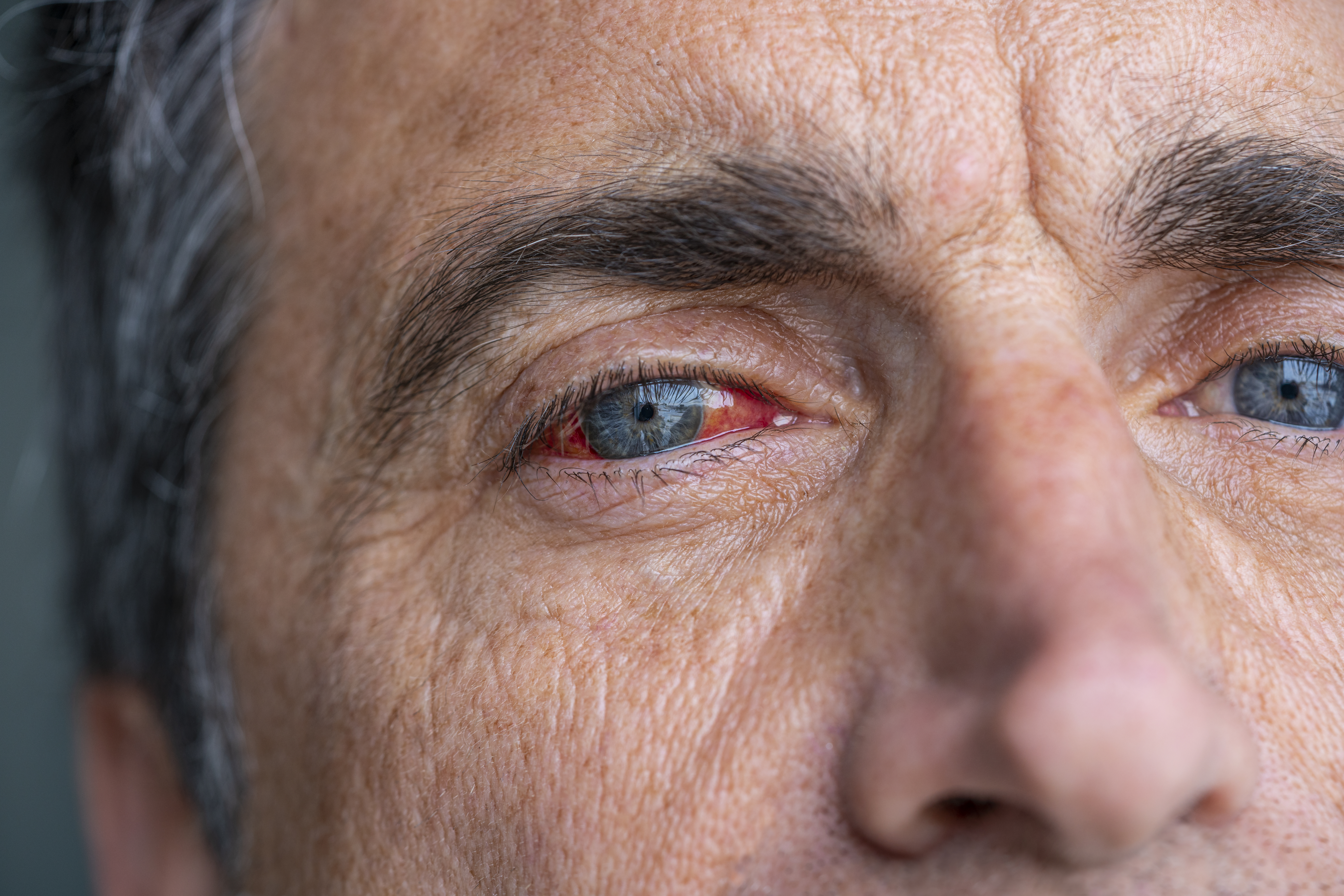 La pérdida de la visión puede desarrollarse por presión arterial alta.