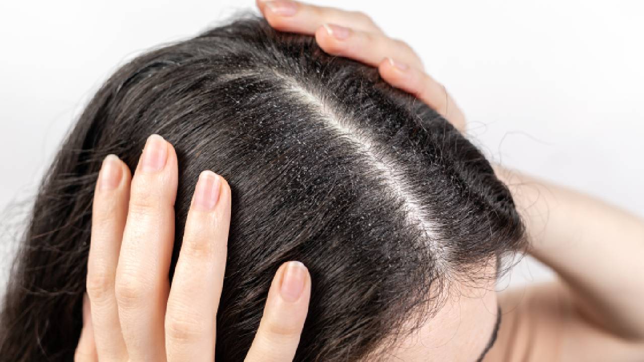 El casero que combate la calvicie y ayuda a detener la caída del cabello