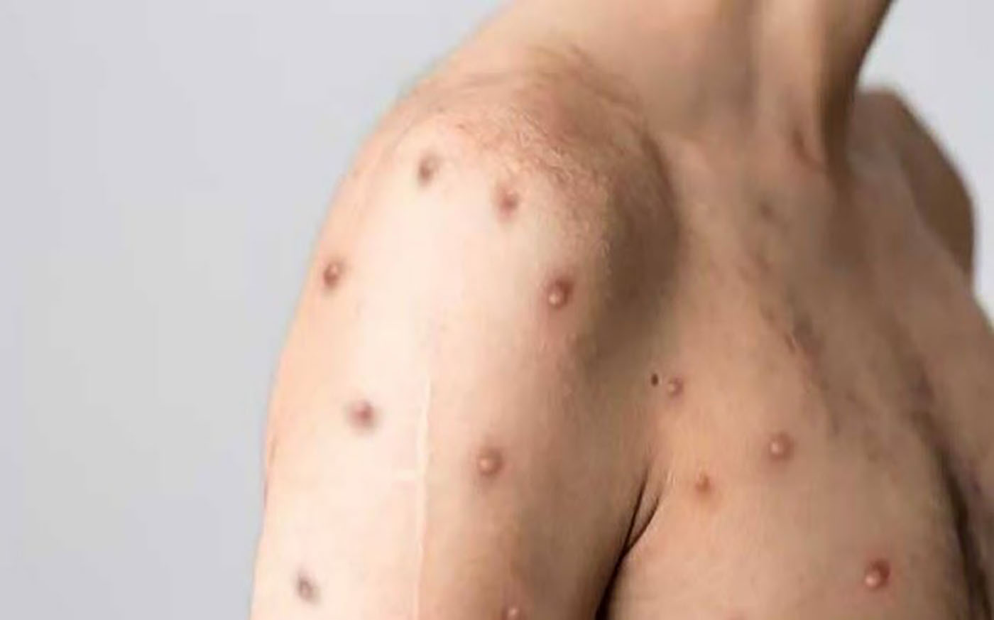 En Colombia se han detectado 4.085 casos de MPox.