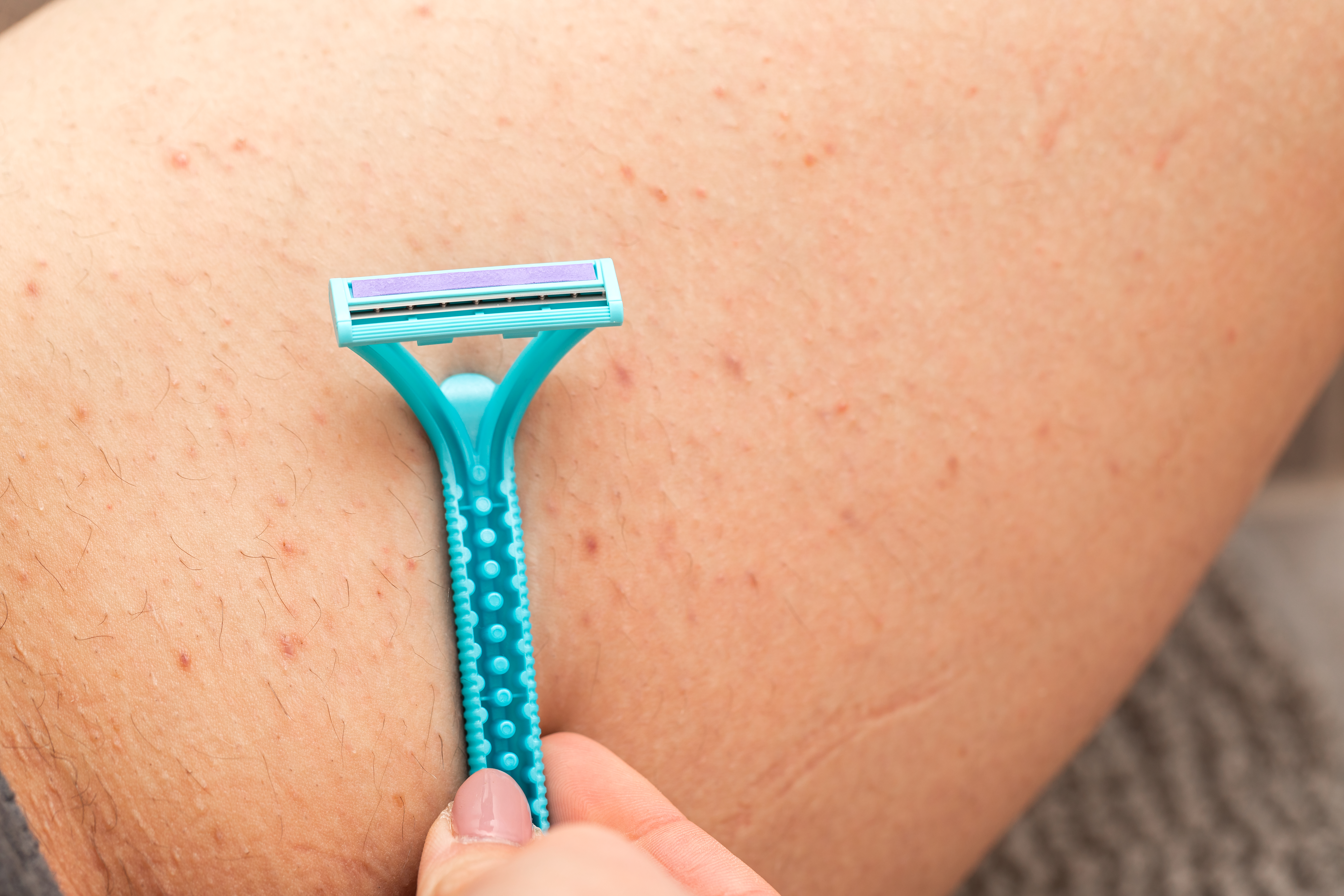 Close up picture of woman holding razor, shaving her hairy leg with folliculitis