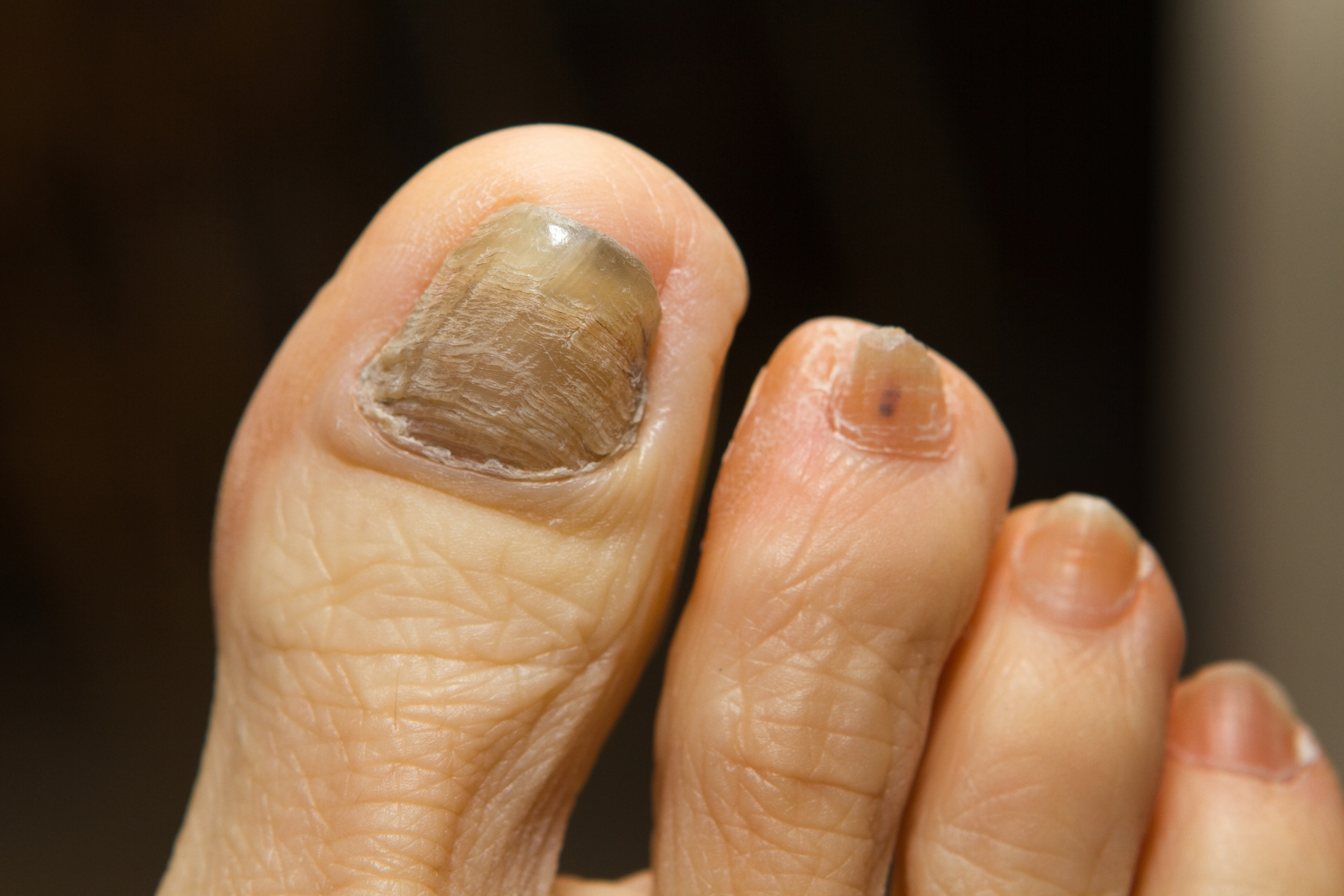 Tratamiento casero para combatir los hongos en las uñas de los pies