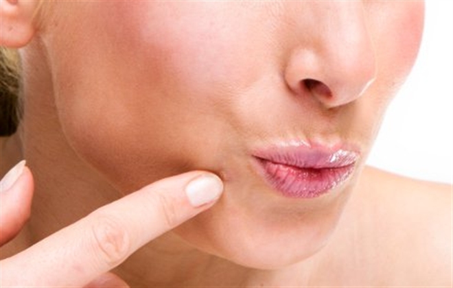 Mascarillas naturales para borrar el acné, foto: Thinkstock