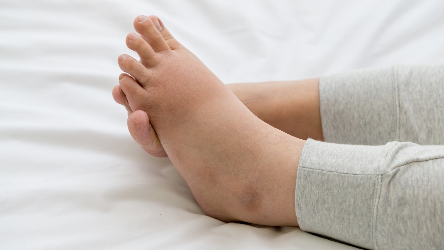 El edema se genera por una hinchazón generada por los líquidos que se quedan atrapados en los tejidos.