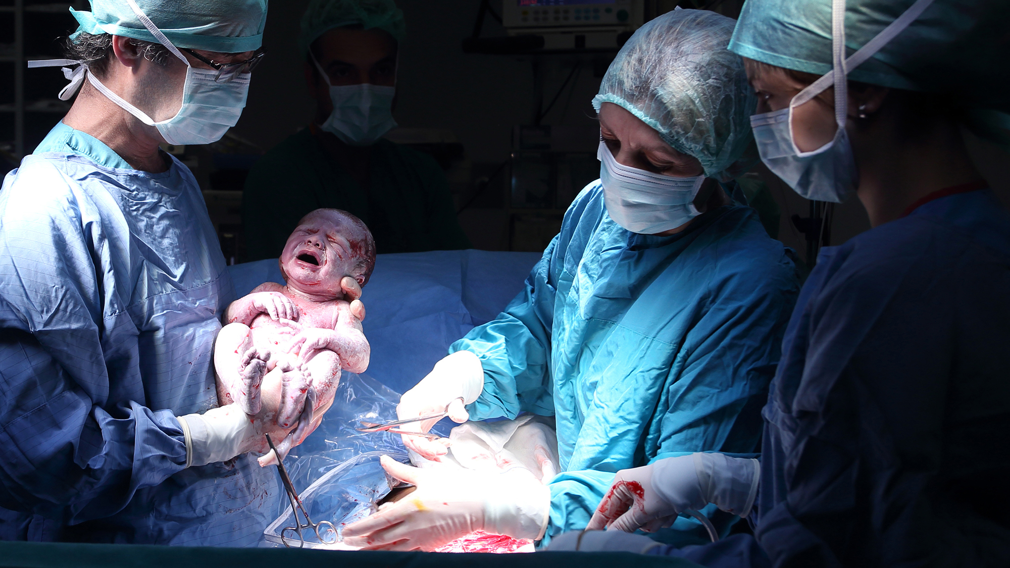 Parto por cesárea en el quirófano