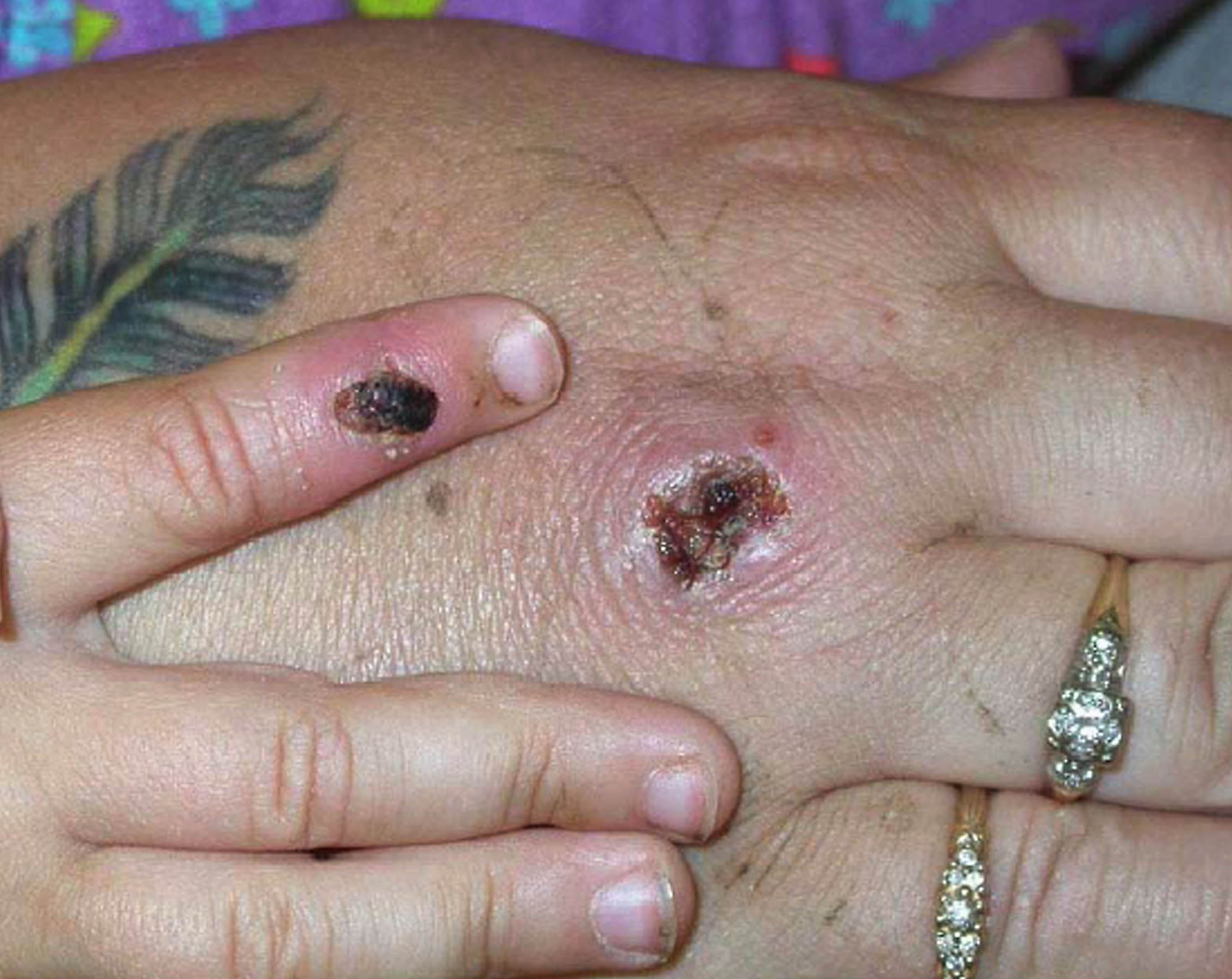 Monkeypox Pictures: How to Identify Symptoms of Monkeypox