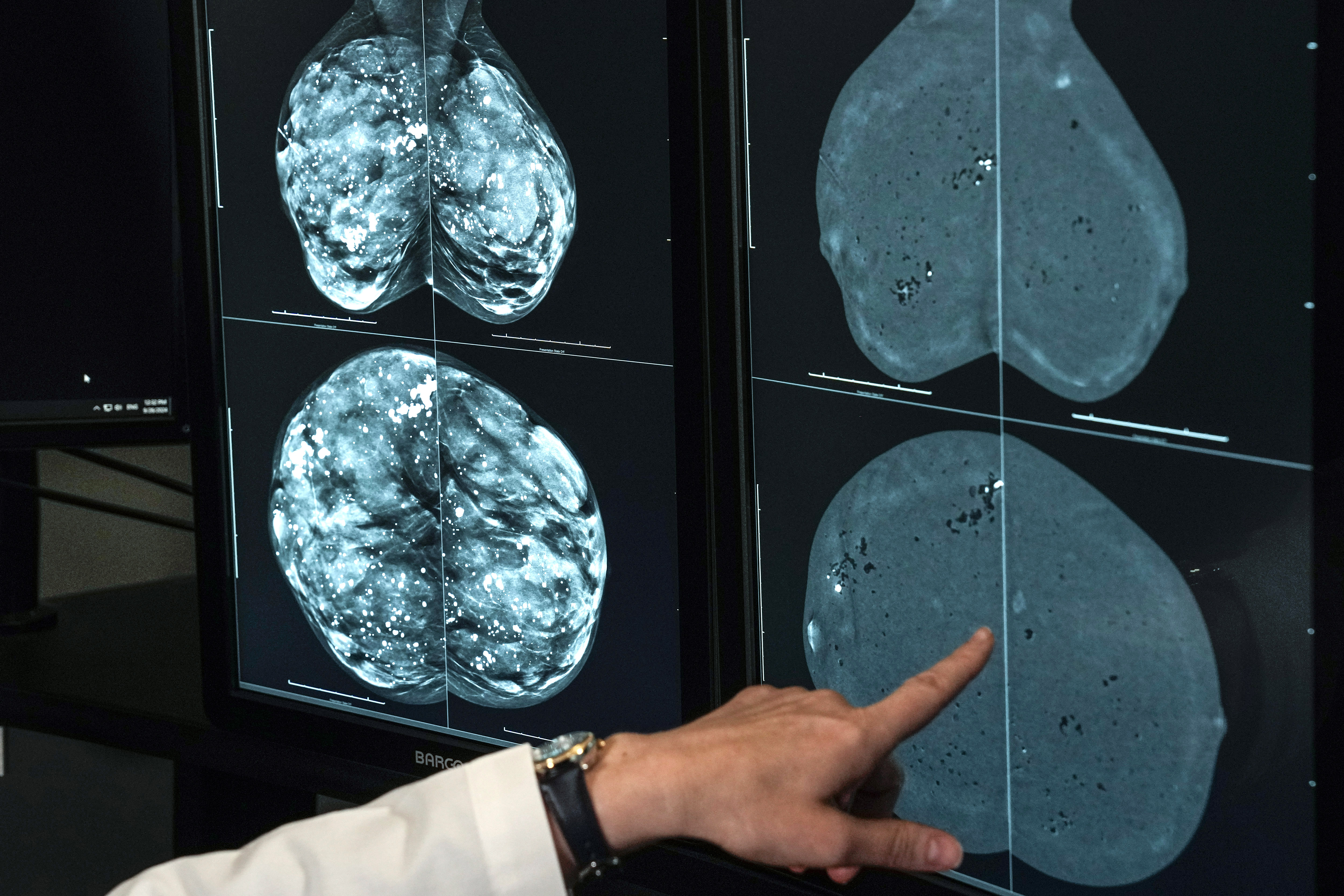 A view of mammogram imagery. The World Health Organization warns that annual global cancer cases could reach 35 million by 2050. (Brett Coomer/Getty)